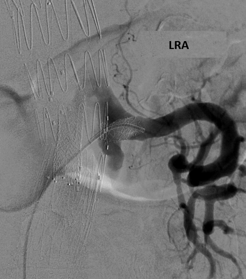 Annals of cardiothoracic surgery, Vol 3, No 3 May 2014 311 Figure 1 Distal type Ib endoleak from a left renal artery and successful treatment with stent-graft extension. LRA, left renal artery.