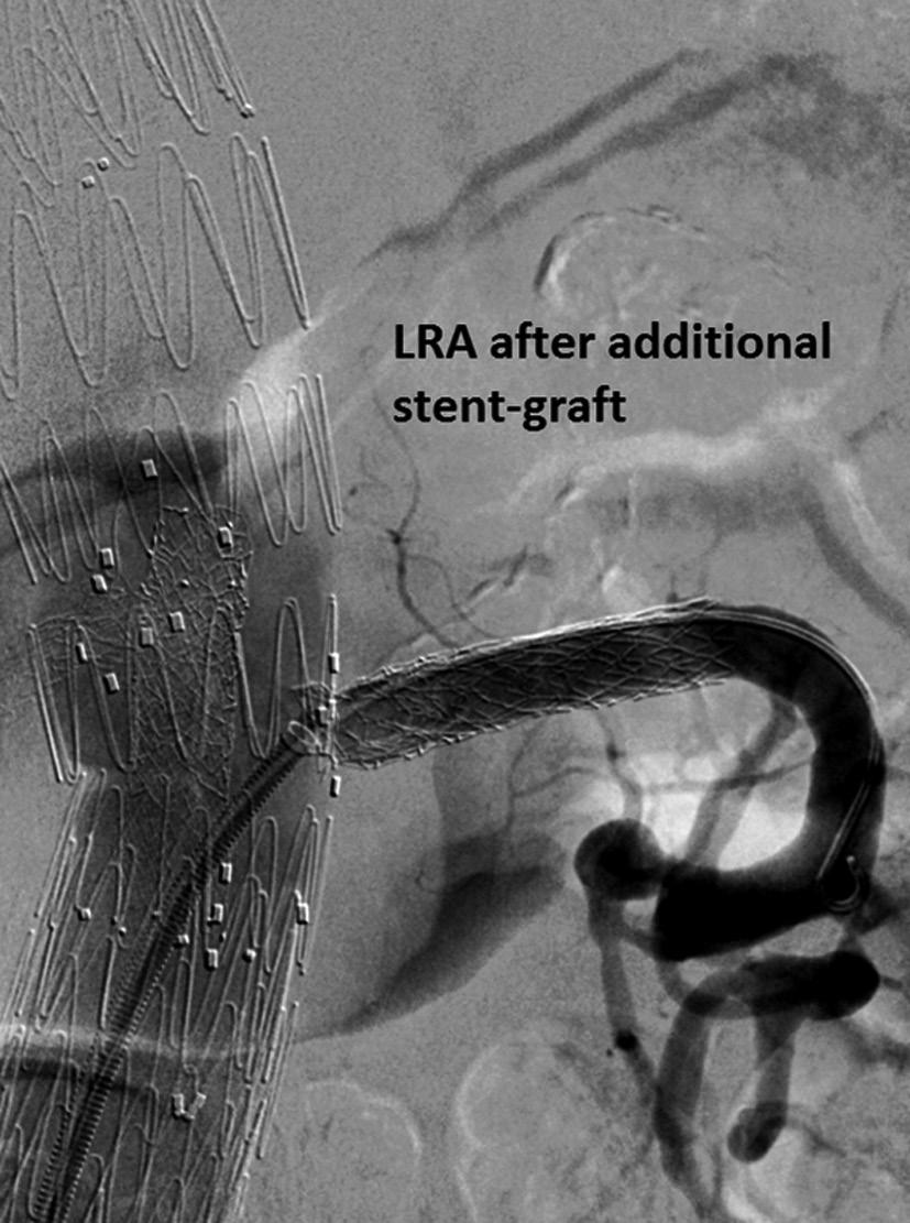 In three cases, the length of the bridging covered stent proved too short after remodeling, resulting in a type Ib endoleak from a side branch.