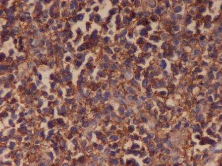 Figure 3: The lymphoma cells show intense cytoplasmic positivity for CD20. CD 20 immunostain x 40 The lymphoma cells were positive for CD20 immunostain, revealing their B cell lineage (Figure 3).