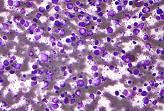Diffuse large B cell (DLBCL) Most common type of NHL, 30-40% of cases Cancer cell appearance led to name cells are large and spread out Can develop in lymph nodes or