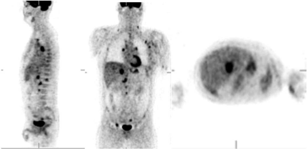Staging and classification of 163 Figure 3 Multiple FDG avid foci were seen involving lymph nodes above and below the diaphragm, liver, and bone marrow.
