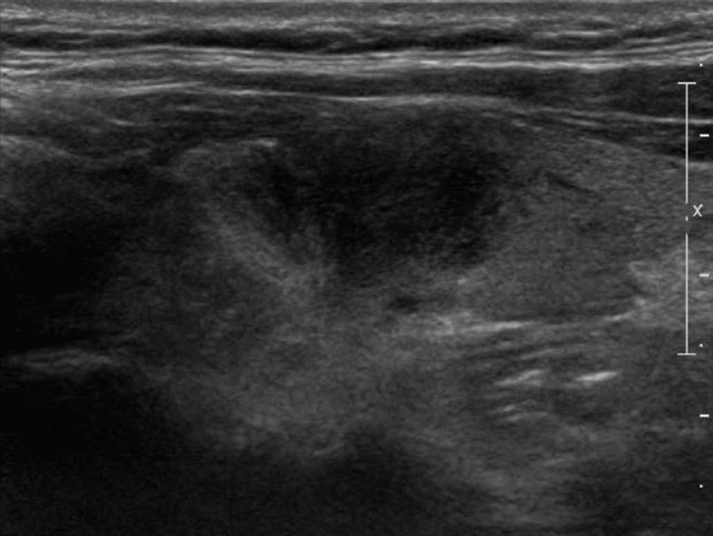 Patients with LT underwent surgery (n=3) because of contralateral cancer, follow-up ultrasonography-guided FNAC or CNB (n=14; interval decrease, 4; no change, 10), or follow-up ultrasonography (n=14;