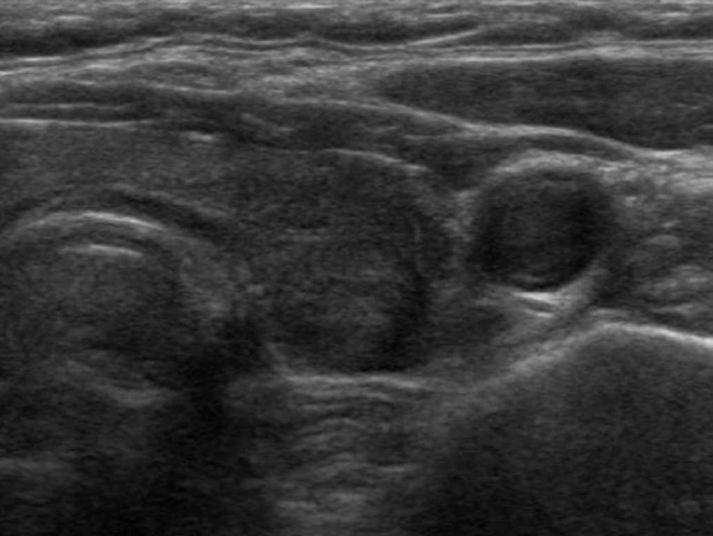 Although in most patients the nodules decreased in size upon follow-up ultrasonography, four patients underwent follow-up ultrasonography-guided FNAC or CNB because of an unchanged, suspicious