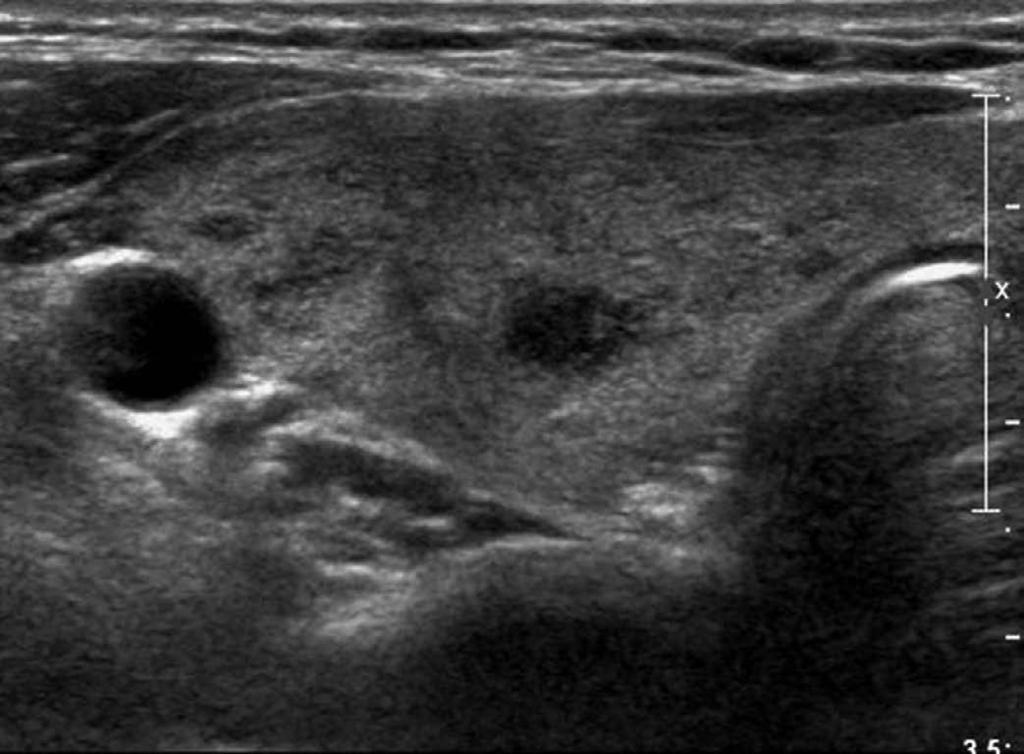 Sang Yu Nam, et al. A B Fig. 2. A 40-year-old woman with papillary thyroid carcinoma (PTC). Transverse (A) and longitudinal (B) ultrasonograms show a 0.