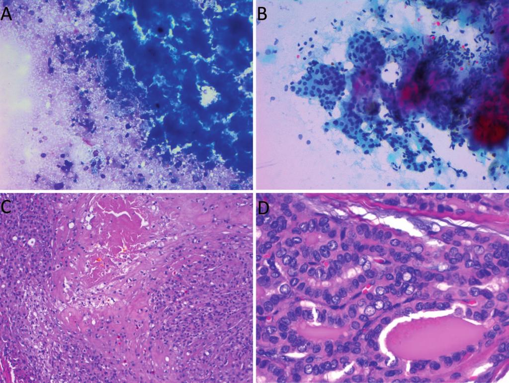 Figure 1. A and B, Thyroid fine-needle aspiration: atypical, insufficient for molecular testing.