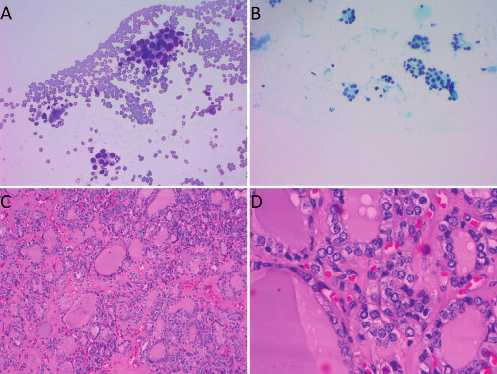 Figure 2. A and B, Thyroid fine-needle aspiration: suspicious for follicular neoplasm, no gene mutations detected.