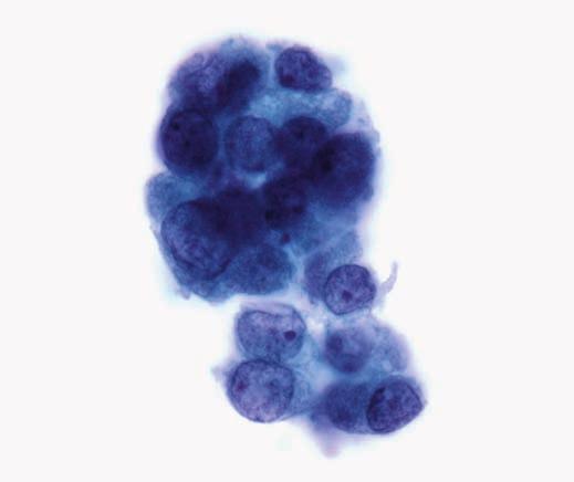 All cases were reported by a staff cytopathologist using a 6-tiered diagnostic system with diagnostic criteria essentially identical to those of the 2007 National Cancer Institute Thyroid FNA State