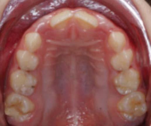 Orthodontic Evaluation Transverse maxillary deficiency (high arched
