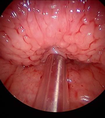 Hypertrophy Prominent lymphoid hyperplasia at the tongue base Treatment: