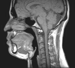 2007; 132:1322-1336 Pharynx susceptibility to collapse Little bony/rigid support from posterior end of nasal septum to the epiglottis Pathophysiology of Obstructive Sleep Apnea Pharyngeal