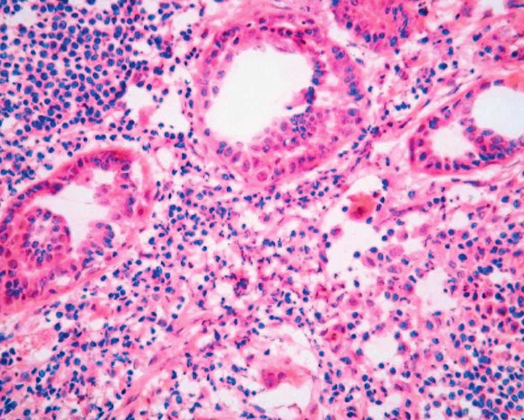 A, Primary invasive ductal carcinoma of the breast (H&E, 200).