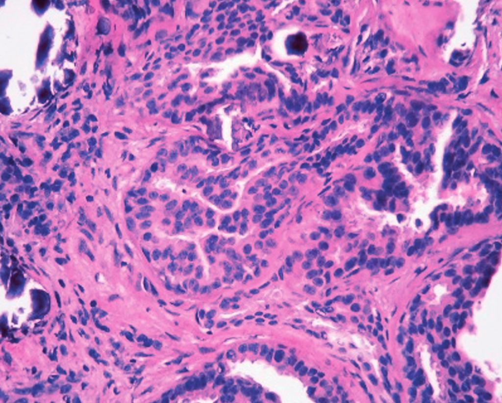 8-mm aggregate with microcalcifications (H&E, 40).