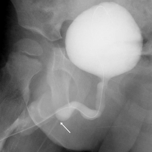 Figure 2: A 34-month-old boy with a congenital anterior urethrocutaneous fistula at the penoscrotal junction.