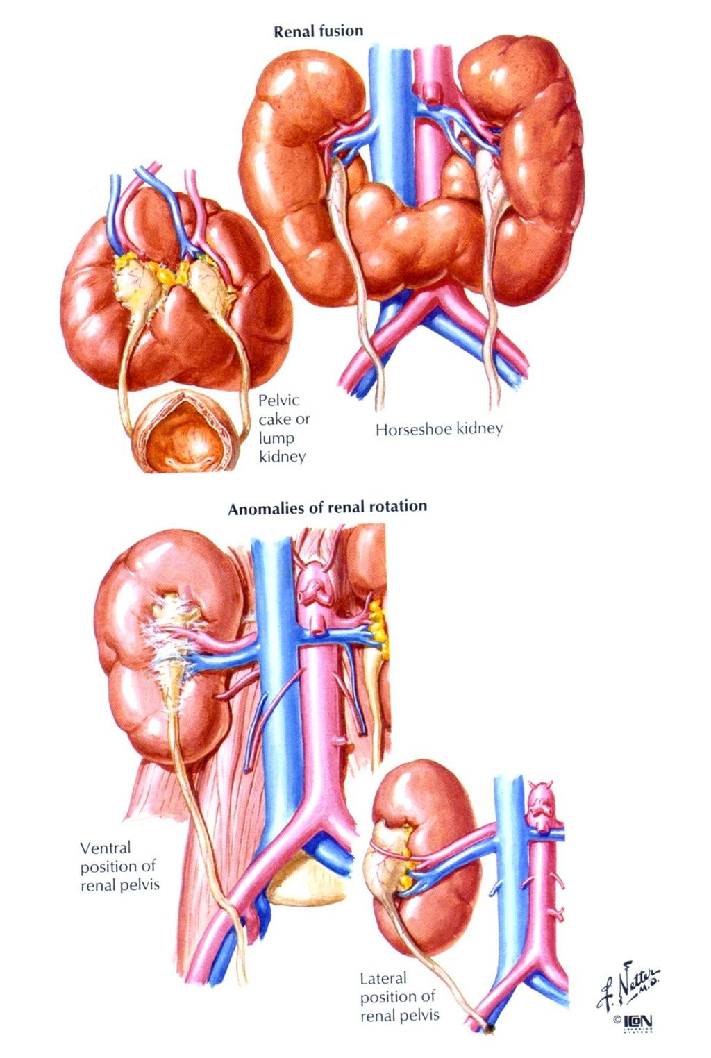 Rosette kidney