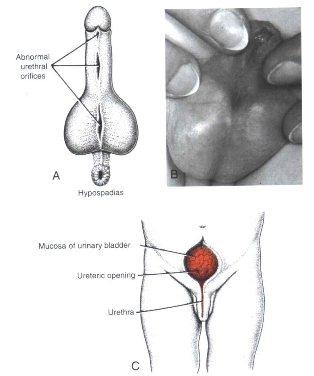 Hypospadias - Fusion of the urethral fold is incomplete