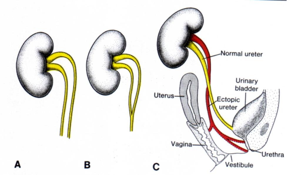 Complete double ureter Partial double