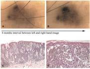 nevus spilus (agminated Spitz) have reported to harbor HRAS mutations