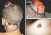 12 lethal childhood melanomas, diagnosed over a 41-year period Expansile nodules, sheet-like growth
