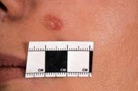 Usually compound - predominantly junctional (Reed), dermal (desmoplastic Spitz) Junctional component: