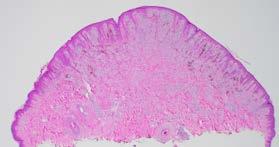 rapidly: mitoses are commonly seen OK as far as they are not marginal Busam KJ, Barnhill RL. Am J Surg Pathol.