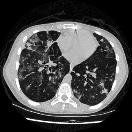 Post Lung Transplant Complication 24 y/o female s/p DLTx for CF 2.5 yrs ago 2-3 weeks of increasing dyspnea, chest tightness & dry cough O2Sat 94-95% Low grade fever What is the diagnosis? 1.