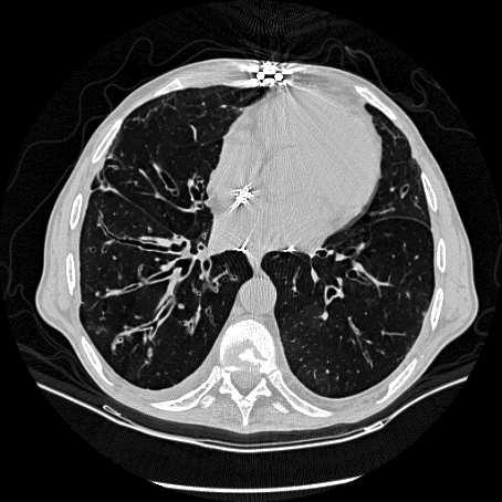 FEV 1 51-65% BOS 3 FEV 1 < 50% Case 6: Post Lung Transplant Complication 64 year old man who underwent double lung transplantation for IPF.