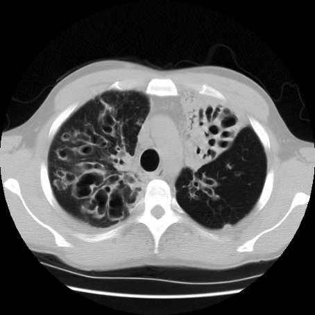 Case 1: Is the patient a candidate for Lung Transplantation?