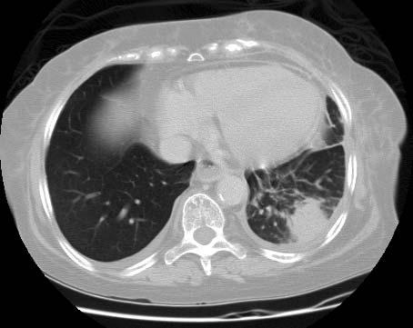 Case 5: Post Lung Transplant Complication 62 y/o female who is one year s/p DLT for