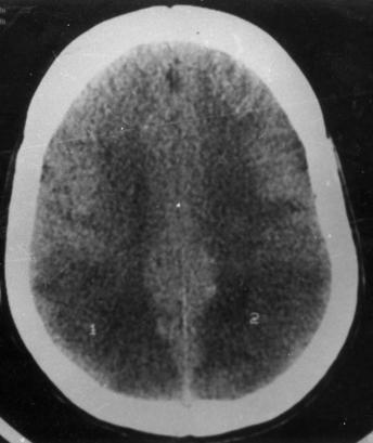 Head CT Scan Brain MRI