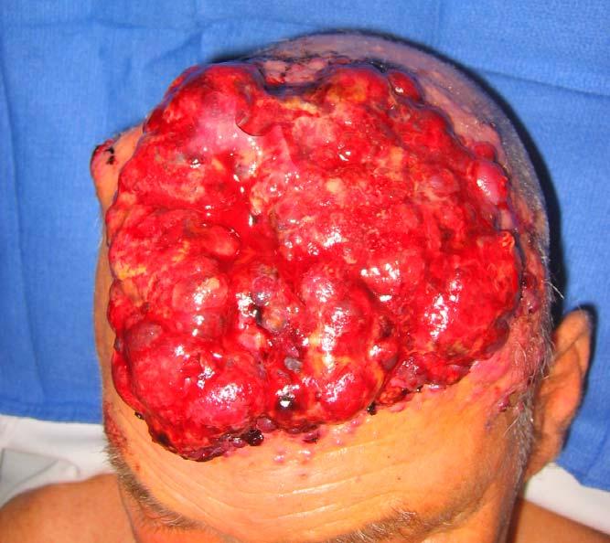 What is the diagnosis? A.