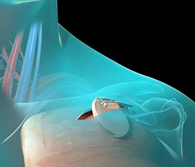 Treatment: Pacemakers Getting a pacemaker does not require open-heart surgery The pacemaker generator is implanted in a small pocket made under the skin.