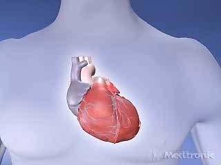 CRT (Cardiac