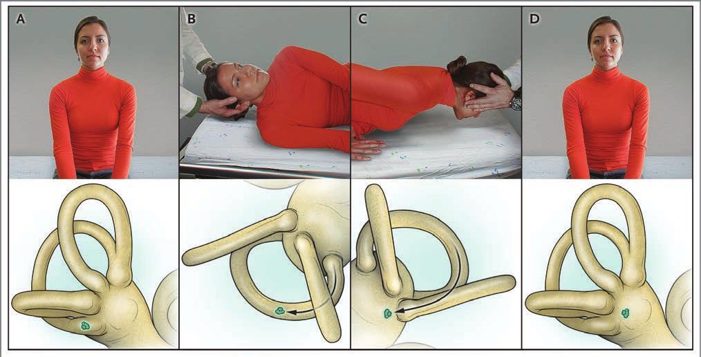 The new england journal of medicine Figure 3. Semont s Repositioning Maneuver for Benign Paroxysmal Positional Vertigo Involving the Right Posterior Semicircular Canal.