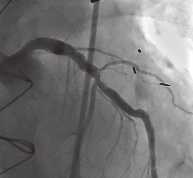 PCI Procedures Chronic Total Occlusion Technical Success With Hybrid Approach (N = 86) 1 1 1 8 6 1 1 Chronic total occlusion (CTO) occurs in about 1% to 3% of patients with indications for coronary
