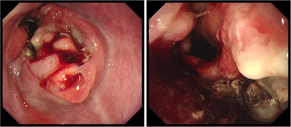 by thoracoscopic esophagectomy in the prone position, with three-field lymph node dissection and gastric tube reconstruction via a posterior mediastinal approach.