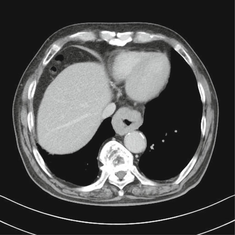 carcinoma components in MANECs are usually represented by adenocarcinoma and NEC [1].