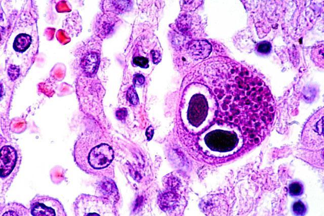 β-herpes Virinae Cytomegalovirus (CMV) It is called CMV because the infected cells are greatly enlarged and multinucleated. Initial infection commonly occurs during childhood.