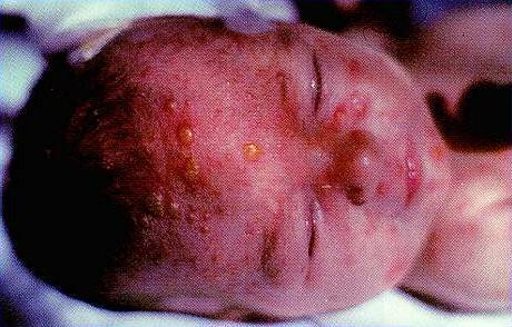 Varicella-zoster virus: chickenpox (Varicella) and shingles (Herpes Zoster) a herpes virus human