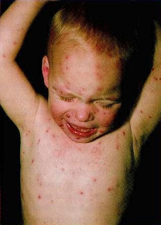 chickenpox papulovesicular rash as of 7/1/01,