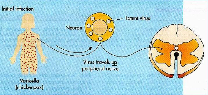 varicella virus