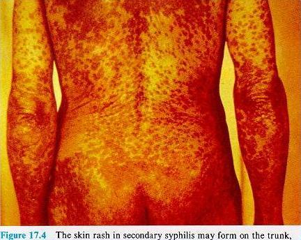 secondary syphilis variable rash often on palms of hands and soles of feet does not itch Still very