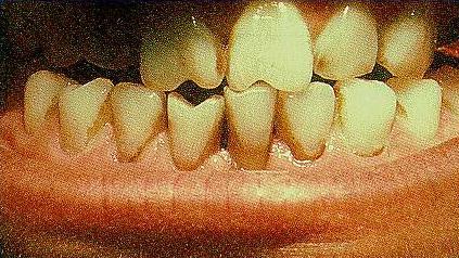 Hutchinsonʼs teeth: