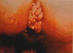 Human papillomaviruses (HPV): genital warts and