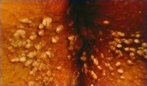 18) associated with 93% of cases of cervical cancer