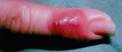 herpes on finger
