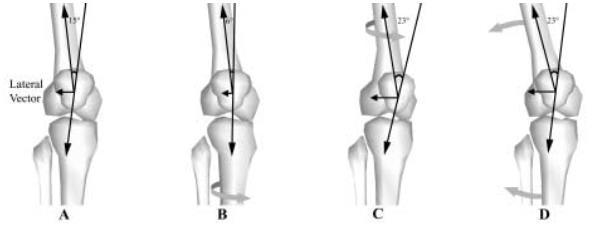 Figure 2.3 The effect of q-angle on lateral patellar maltracking.