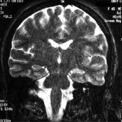Mesial Temporal Sclerosis Management CBC, BMP CT brain MRI brain EEG LP <6M, >12M Admit to PICU Admit to hospital Conditions That Mimic Seizures Breath holding spells Shuddering attacks Sandifer
