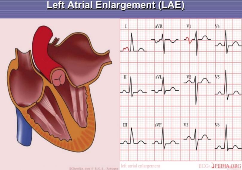 Afib as a marker for atrial cardiopathy Often cohabitates with other atrial abnormalities Fibrosis