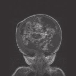 (b) coronal image, (c) sagittal image showing a large