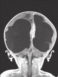 septa. DISCUSSION Congenital intracranial tumors account for approximately 0.5-1.5% of all childhood brain tumors. 2 Germ cell tumors comprise 0.4-3.